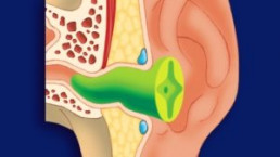 Schematische Darstellung einer individuellen Gehörschutzotoplastik, die sich genau passend in den Gehörgang einfügt.