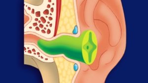 Schematische Darstellung einer individuellen Gehörschutzotoplastik, die sich genau passend in den Gehörgang einfügt.