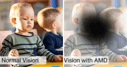 Visualisierung: Sicht mit AMD-Makuladegeneration