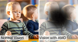 Visualisierung: Vergleich von normaler Sicht und Sicht mit AMD-Makuladegeneration